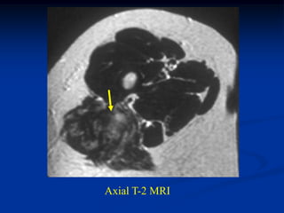 Axial T-2 MRI
 