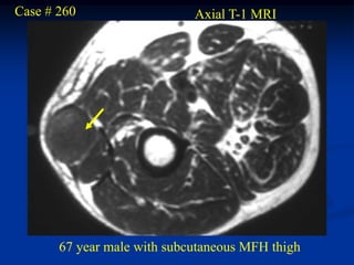 Case # 260                   Axial T-1 MRI




       67 year male with subcutaneous MFH thigh
 