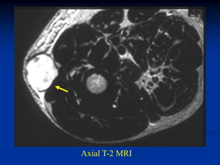 Axial T-2 MRI
 