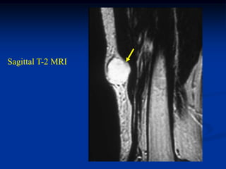 Sagittal T-2 MRI
 
