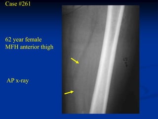 Case #261




62 year female
MFH anterior thigh




AP x-ray
 