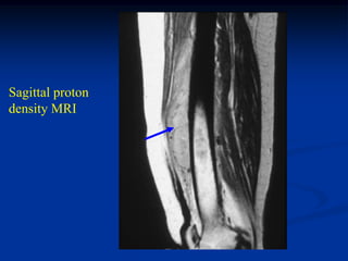 Sagittal proton
density MRI
 