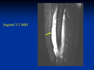 Sagittal T-2 MRI
 