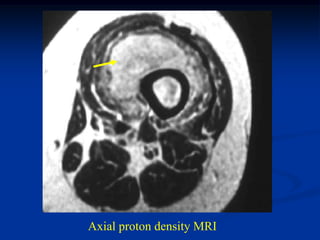 Axial proton density MRI
 