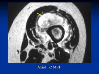 Axial T-2 MRI
 