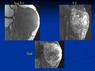 Sag T-1         T-2




          Gad
 