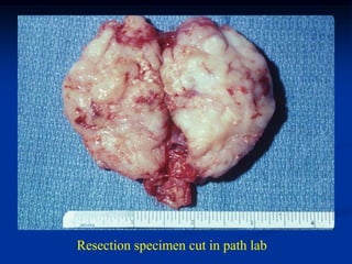 Resection specimen cut in path lab
 