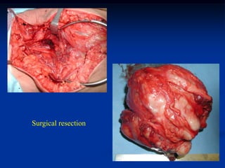 Surgical resection
 