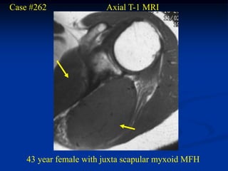 Case #262               Axial T-1 MRI




    43 year female with juxta scapular myxoid MFH
 