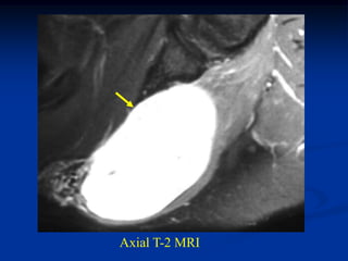 Axial T-2 MRI
 