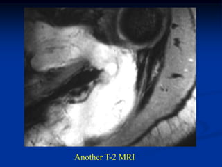 Another T-2 MRI
 