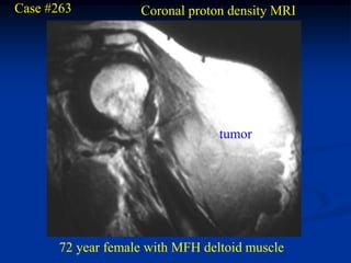 Case #263           Coronal proton density MRI




                                  tumor




       72 year female with MFH deltoid muscle
 