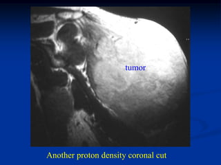 tumor




Another proton density coronal cut
 