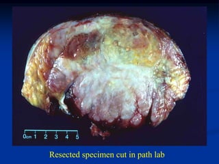 Resected specimen cut in path lab
 