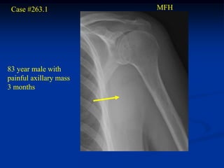 Case #263.1            MFH




83 year male with
painful axillary mass
3 months
 