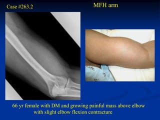 Case #263.2                         MFH arm




  66 yr female with DM and growing painful mass above elbow
           with slight elbow flexion contracture
 