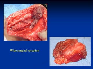 Wide surgical resection
 