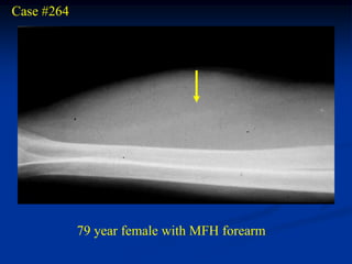 Case #264




            79 year female with MFH forearm
 