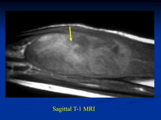 Sagittal T-1 MRI
 
