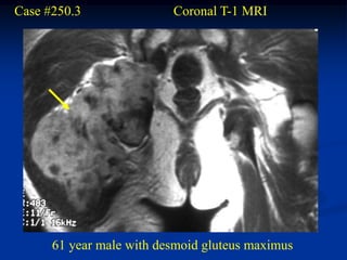 Case #250.3               Coronal T-1 MRI




      61 year male with desmoid gluteus maximus
 