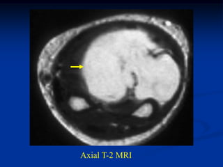Axial T-2 MRI
 