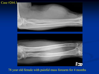 Case #264.1




    78 year old female with painful mass forearm for 4 months
 