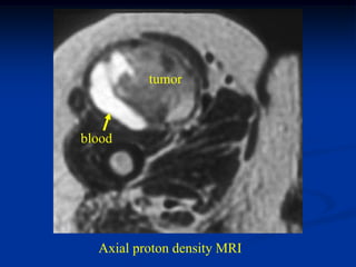 tumor



blood




  Axial proton density MRI
 