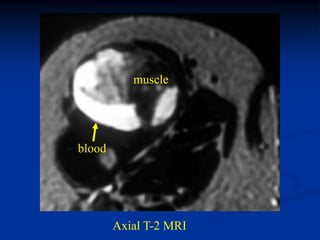 muscle




blood




        Axial T-2 MRI
 
