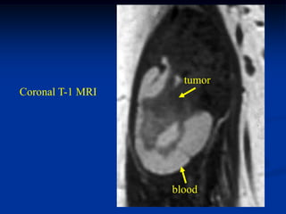 tumor
Coronal T-1 MRI




                  blood
 
