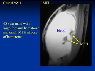 Case #265.1              MFH




45 year male with
large forearm hematoma
and small MFH at base          blood
of hematoma
                                       MFH
 