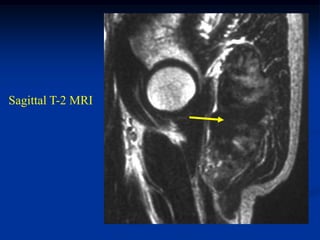 Sagittal T-2 MRI
 