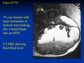 Case #1174



78 year female with
large hematoma in
buttock area looking
like a hemorrhage
into an MFH


T-2 MRI showing
fluid-fluid level
 