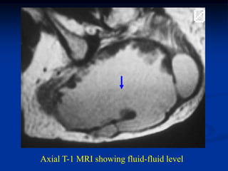 Axial T-1 MRI showing fluid-fluid level
 