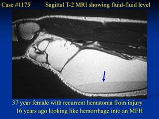 Case #1175     Sagittal T-2 MRI showing fluid-fluid level




   37 year female with recurrent hematoma from injury
    16 years ago looking like hemorrhage into an MFH
 