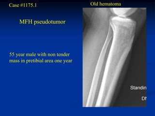 Case #1175.1                      Old hematoma


    MFH pseudotumor




55 year male with non tender
mass in pretibial area one year
 