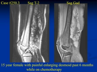 Case #250.3      Sag T-2                 Sag Gad




15 year female with painful enlarging desmoid past 6 months
                while on chemotherapy
 