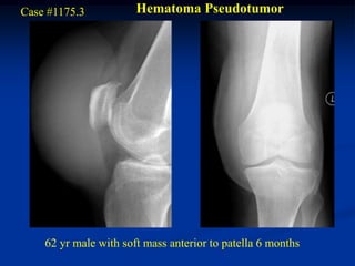Case #1175.3           Hematoma Pseudotumor




    62 yr male with soft mass anterior to patella 6 months
 