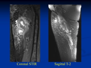 Coronal STIR   Sagittal T-2
 