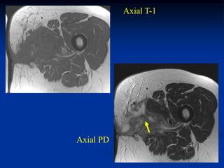 Axial T-1




Axial PD
 