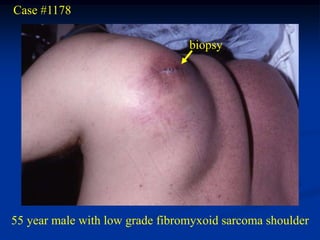 Case #1178

                                 biopsy
                                 biopsy




55 year male with low grade fibromyxoid sarcoma shoulder
 