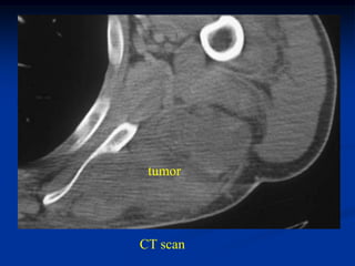 tumor




CT scan
 
