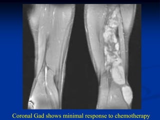 Coronal Gad shows minimal response to chemotherapy
 