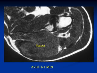 tumor




Axial T-1 MRI
 