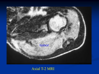 tumor




Axial T-2 MRI
 