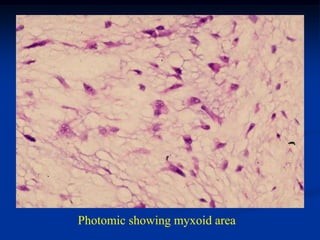 Photomic showing myxoid area
 