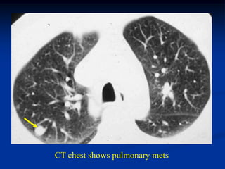 CT chest shows pulmonary mets
 