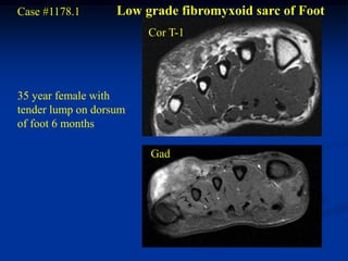Case #1178.1       Low grade fibromyxoid sarc of Foot
                        Cor T-1




35 year female with
tender lump on dorsum
of foot 6 months

                        Gad
 