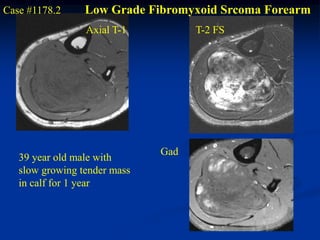 Case #1178.2     Low Grade Fibromyxoid Srcoma Forearm
                 Axial T-1          T-2 FS




                              Gad
   39 year old male with
   slow growing tender mass
   in calf for 1 year
 