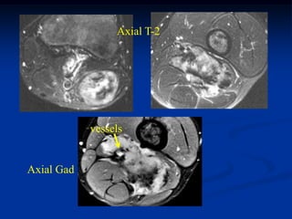 Axial T-2




            vessels


Axial Gad
 