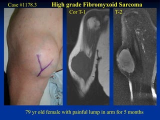 Case #1178.3      High grade Fibromyxoid Sarcoma
                           Cor T-1             T-2




       79 yr old female with painful lump in arm for 5 months
 